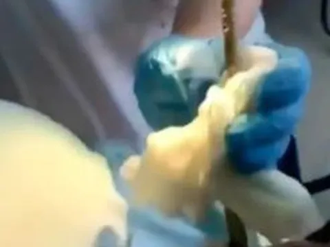 Đang ngủ ngoài sân, người phụ nữ sốc nặng khi bị con rắn 1,2m chui vào miệng