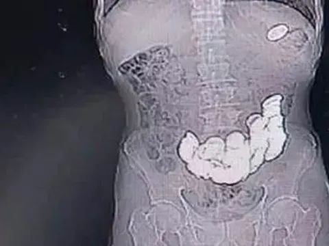 Người đàn ông 33 tuổi bụng phình to như quả bóng, bác sĩ gắp ra thứ "đáng sợ" bên trong