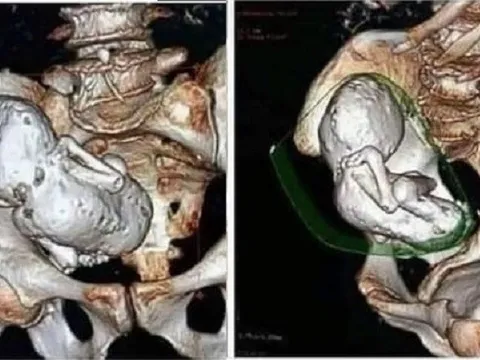 Chụp CT cho cụ bà 73 tuổi, bác sĩ sốc nặng khi phát hiện thai nhi hóa đá 30 năm