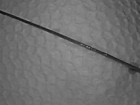 Người đàn ông 68 tuổi bỗng đau bụng dữ dội, bác sĩ lấy ra thứ "đáng sợ" bên trong