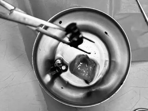 Bé trai 4 tuổi đau bụng dữ dội, nôn ói, bác sĩ gắp ra thứ "đáng sợ" bên trong