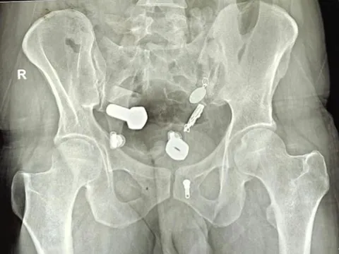 Người đàn ông 34 tuổi bị đau bụng, bác sĩ sốc khi phát hiện thứ "đáng sợ" bên trong