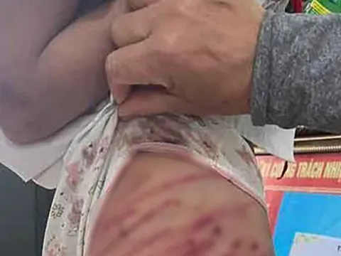 Hà Tĩnh: Xác minh vụ bé gái lớp 5 bị cha dượng bạo hành phải nhập viện