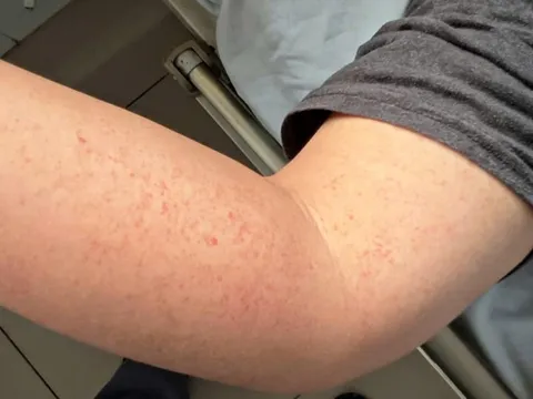 Bất kỳ ai cũng có thể mắc sốt xuất huyết và nguy cơ bệnh nặng