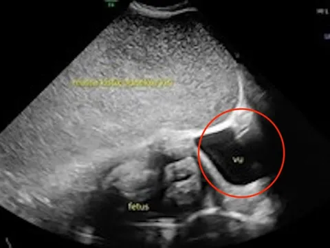 Thai phụ 26 tuổi kêu đau dạ dày, bác sĩ sốc nặng khi phát hiện "bí mật" đáng sợ