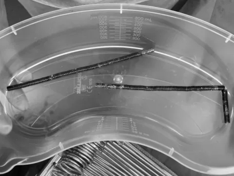 Bé trai 13 tuổi đau bụng dữ dội, bác sĩ phát hiện bí mật "đáng sợ" bên trong