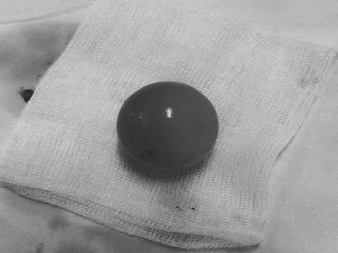 Bé trai 14 tháng tuổi nôn nhiều, bố mẹ bất ngờ khi bác sĩ gắp ra thứ "đáng sợ" trong bụng