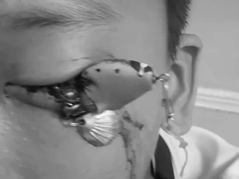 Bé trai 12 tuổi đau mắt dữ dội, bác sĩ gắp ra thứ "đáng sợ" bên trong