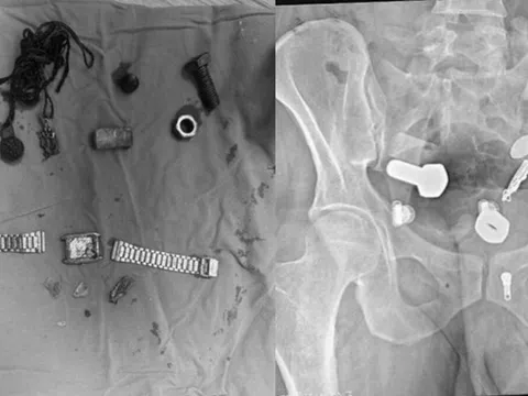 Người đàn ông liên tục đau bụng, bác sĩ sốc nặng khi phát hiện "bí mật" đáng sợ