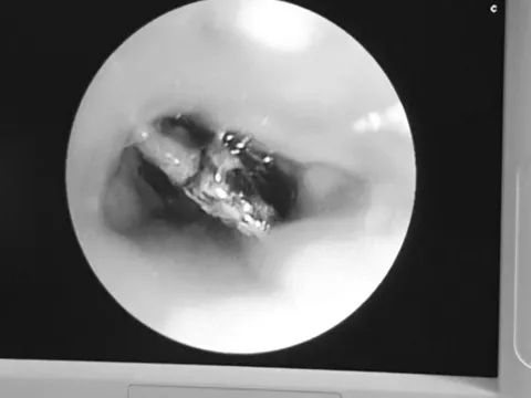 Người phụ nữ 65 tuổi ho suốt ngày, đến viện bác sĩ gắp ra thứ "đáng sợ" bên trong