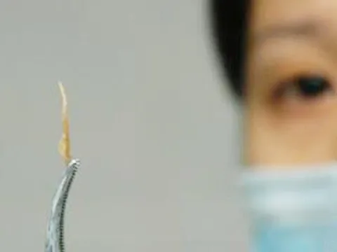 Suýt thủng phế quản vì… mảnh xương cá “đi lạc” suốt 3 tuần trong phổi