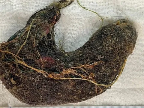 Bé trai đau bụng suốt 2 tháng, bác sĩ phát hiện ra "bí mật" đáng sợ