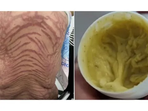 Buồn nôn, tê tay, người phụ nữ xuất hiện thứ "đáng sợ" trên lưng