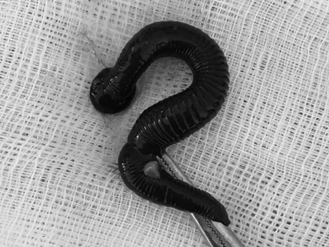 Cụ bà 72 tuổi ngứa mũi liên tục, bác sĩ gắp ra thứ "đáng sợ" bên trong