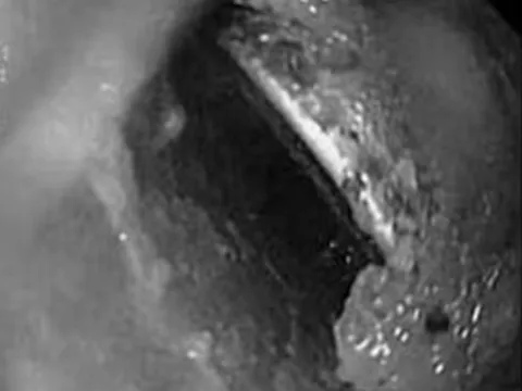 Bé trai bị loét sâu thực quản, bác sĩ gắp ra thứ "đáng sợ" bên trong