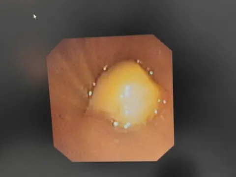 Bé hơn 2 tuổi xẹp phổi vì nuốt phải thứ hạt "vạn người mê"