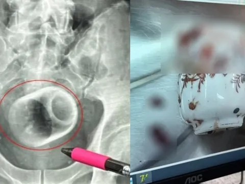 Người đàn ông bị chướng bụng, bác sĩ phát hiện ra bí mật đáng sợ