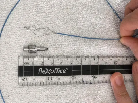 BV Hữu Nghị cấp cứu thành công ca dị vật phế quản nguy hiểm hiếm gặp