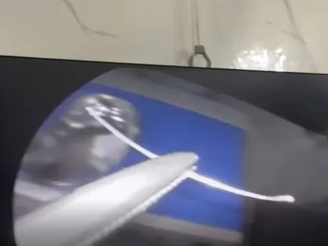 Người đàn ông đau họng dữ dội, bác sĩ gắp ra thứ "đáng sợ" bên trong