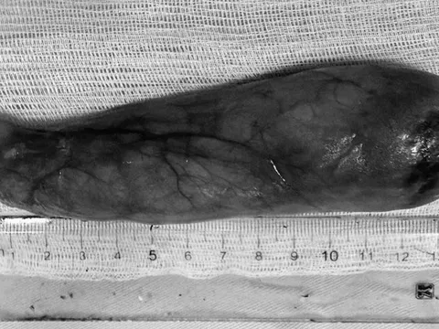 Một tháng chịu nghẹn, người phụ nữ 59 tuổi bàng hoàng khi biết thứ "đáng sợ" nằm trong cổ họng