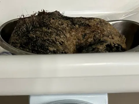 Bé gái 6 tuổi đau bụng dữ dội, bác sĩ gắp ra thứ "đáng sợ"