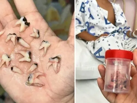 Bé trai phải nhổ 12 răng cùng lúc vì thói quen tưởng vô hại nhưng cực nguy hiểm