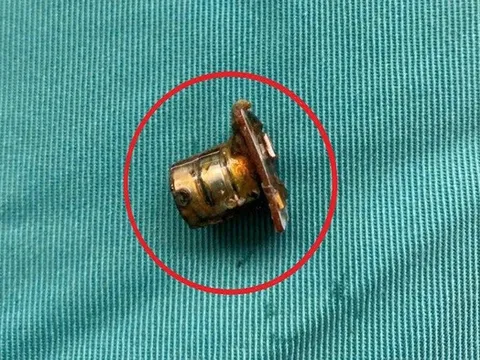 Bé 2 tuổi đang chơi bỗng ho tím tái, bác sĩ gắp ra thứ "đáng sợ" trong bụng