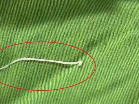 Đau bụng âm ỉ, đến viện bác sĩ gắp ra thứ "đáng sợ" bên trong