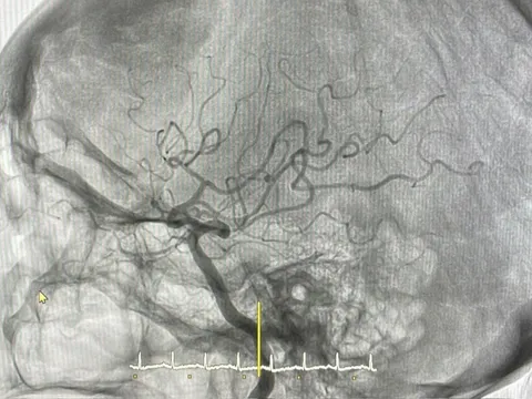 Cấp cứu thành công bệnh nhân đột quỵ não do tắc động mạch não giữa bằng kỹ thuật hút huyết khối