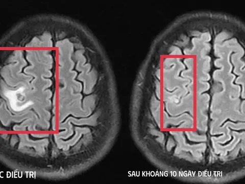 Cơn co giật bất thường hé lộ “vị khách lạ” ký sinh trong não