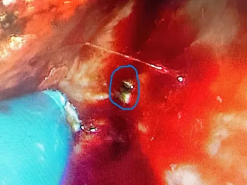 Bệnh viện Hữu nghị phẫu thuật thành công ca dị vật vách ngăn mũi tồn dư hơn 40 năm