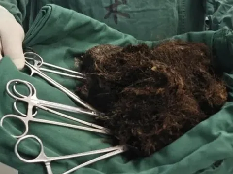 Người phụ nữ bụng "cứng như đá", bác sĩ phát hiện ra bí mật đáng sợ