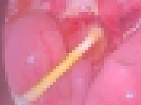 Bé 5 tuổi đau bụng kéo dài, gia đình sốc nặng khi bác sĩ gắp ra thứ "đáng sợ" trong bụng bé