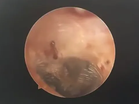 Nghe thấy âm thanh lạ trong tai, người phụ nữ đi khám thì sốc nặng