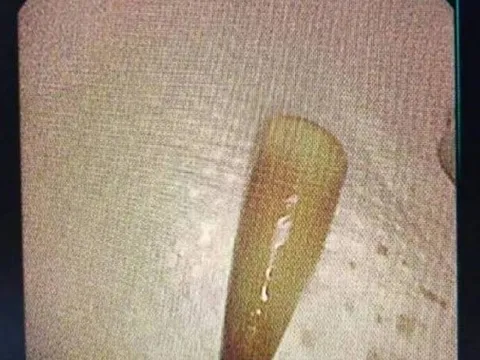 Người đàn ông liên tục ho ra máu, bác sĩ lấy ra thứ "đáng sợ" trong phổi