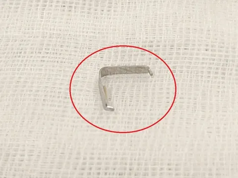 Bé trai 1 tuổi cứ ăn là nôn ọe, bác sĩ phát hiện "bí mật" bên trong