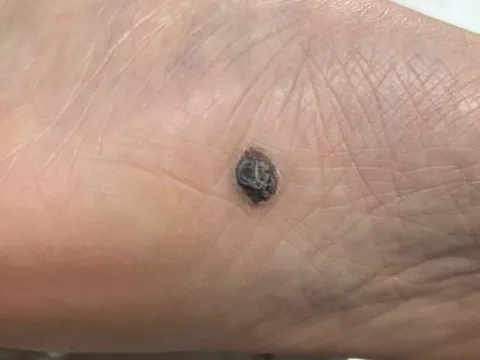 5 dấu hiệu nốt ruồi có thể là ung thư da, dấu hiệu số 1 dễ bị bỏ qua