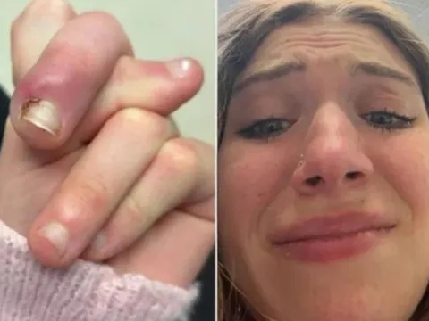 Người phụ nữ 21 tuổi suýt mất ngón vì thói quen "vạn người mê"