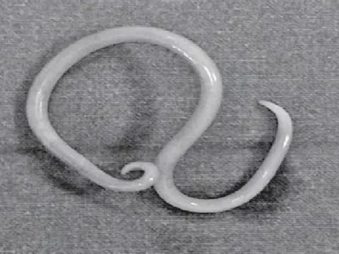 Thiếu niên 15 tuổi bị đau bụng thúc ngược lên, bác sĩ phát hiện "bí mật" đáng sợ bên trong