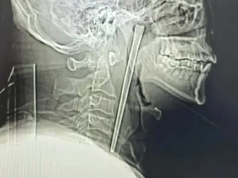 Người đàn ông đau họng dữ dội, bác sĩ lấy ra thứ đáng sợ bên trong