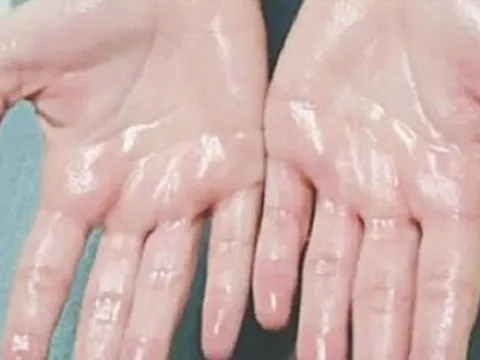 Cách kiểm soát tình trạng ra mồ hôi tay hiệu quả bậc nhất