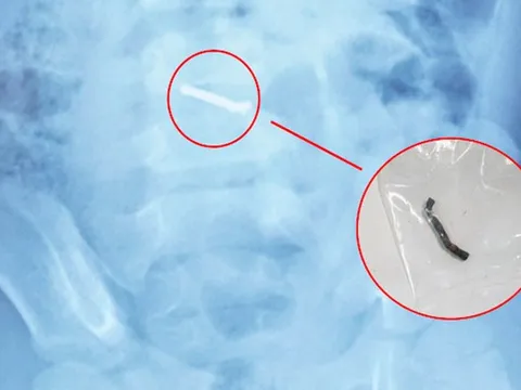 Bé trai 5 tuổi nuốt hàng chục viên nam châm gây thủng ruột
