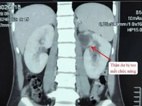 Kỳ lạ cô gái 22 tuổi có 3 quả thận