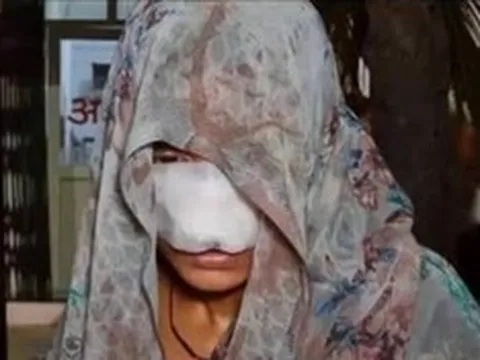 Cãi nhau, chồng cắn vào mũi và má khiến vợ phải khâu 10 mũi