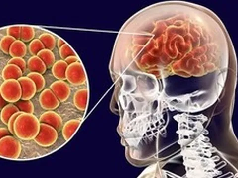 Ca bệnh do não mô cầu gia tăng