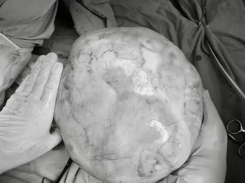 Phát hiện khối u "khủng" trong bụng bé gái 14 tuổi