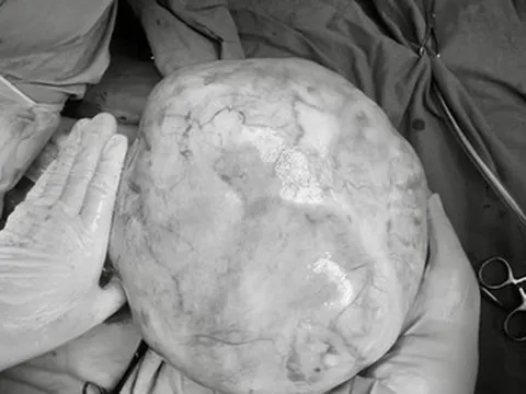 Bé gái 14 tuổi bụng to bất thường, bố mẹ sốc khi phát hiện bí mật "đáng sợ" bên trong