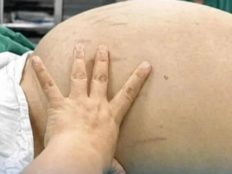 Thiếu nữ 19 tuổi bụng to như bầu, bác sĩ phát hiện bí mật "đáng sợ" bên trong