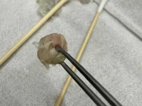 Bé gái 6 tuổi nhập viện khẩn cấp, bố mẹ "sốc" khi bác sĩ lấy ra thứ "đáng sợ" từ mũi con