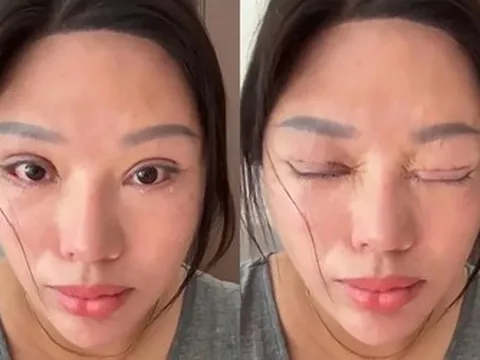 Người phụ nữ 6 năm không thể nhắm mắt khi ngủ, lý do phía sau khiến nhiều người bất ngờ